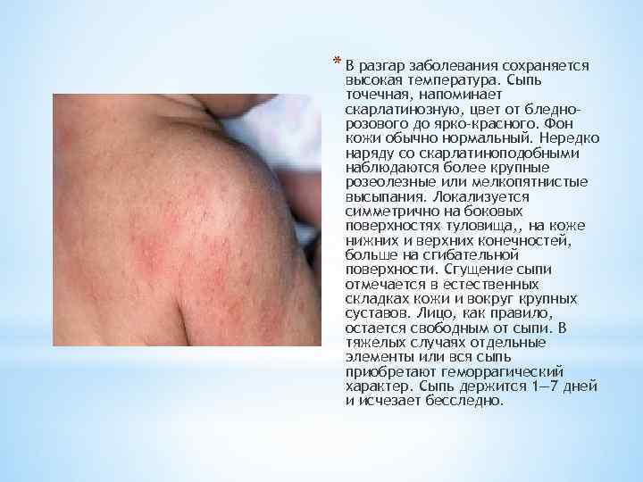 * В разгар заболевания сохраняется высокая температура. Сыпь точечная, напоминает скарлатинозную, цвет от бледнорозового