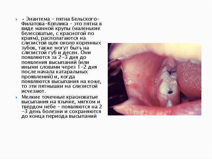  • Энантема - пятна Бельского. Филатова-Коплика – это пятна в виде манной крупы