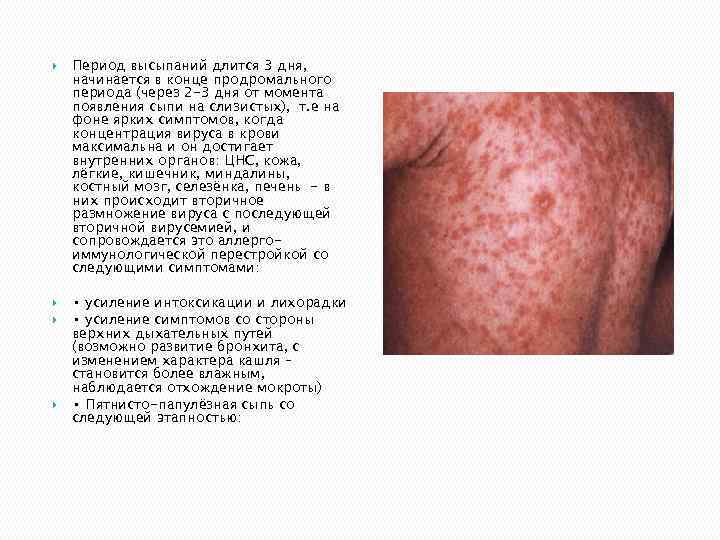  Период высыпаний длится 3 дня, начинается в конце продромального периода (через 2 -3