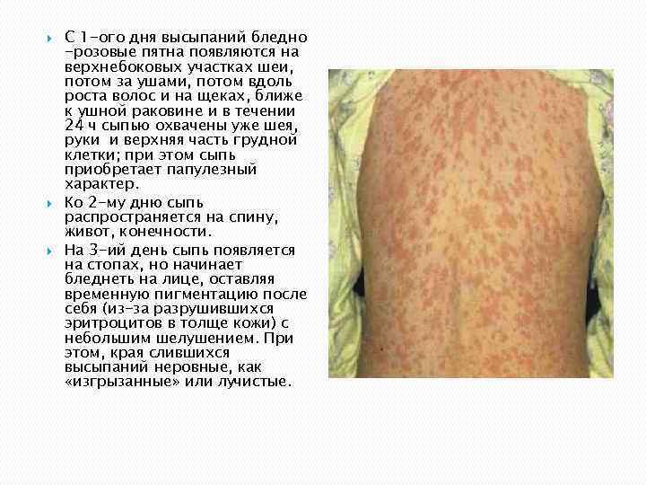  С 1 -ого дня высыпаний бледно -розовые пятна появляются на верхнебоковых участках шеи,