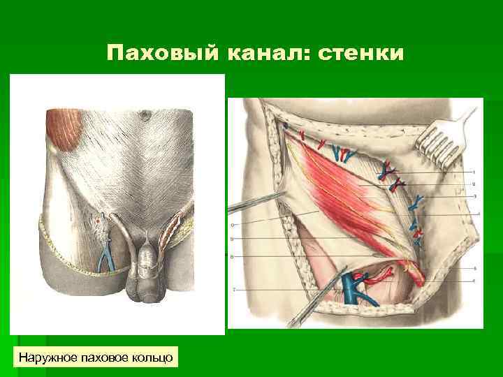 Паховый канал: стенки Наружное паховое кольцо 