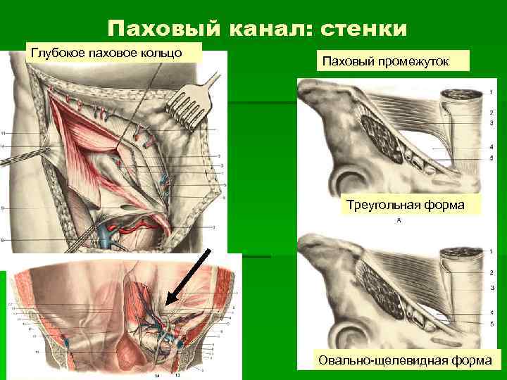 Паховый канал: стенки Глубокое паховое кольцо Паховый промежуток Треугольная форма Овально-щелевидная форма 