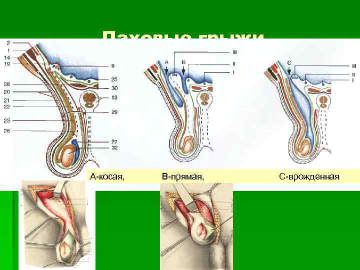 Паховые грыжи А-косая, В-прямая, С-врожденная 