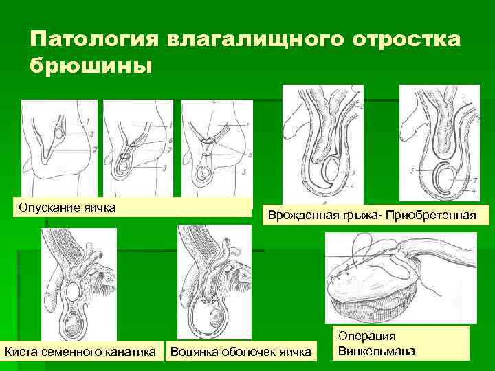 Патология влагалищного отростка брюшины Опускание яичка Киста семенного канатика Врожденная грыжа- Приобретенная Водянка оболочек