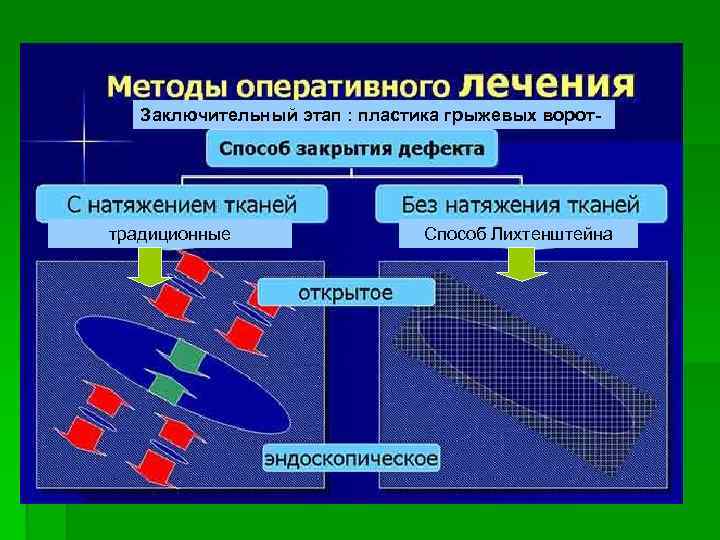 Заключительный этап : пластика грыжевых ворот- традиционные Способ Лихтенштейна 