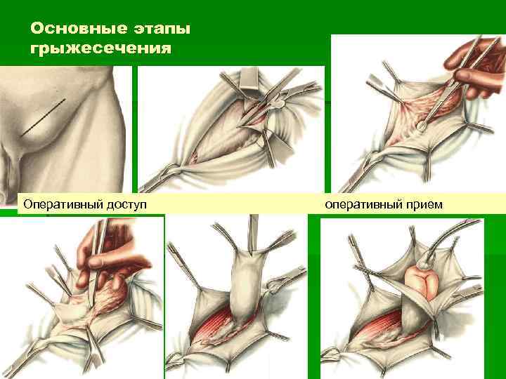 Основные этапы грыжесечения Оперативный доступ оперативный прием 