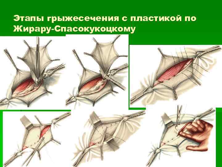 Этапы грыжесечения с пластикой по Жирару-Спасокукоцкому 