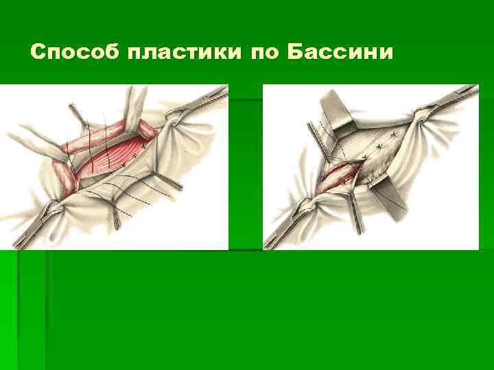 Способ пластики по Бассини 