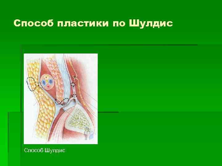 Способ пластики по Шулдис Способ Шулдис 