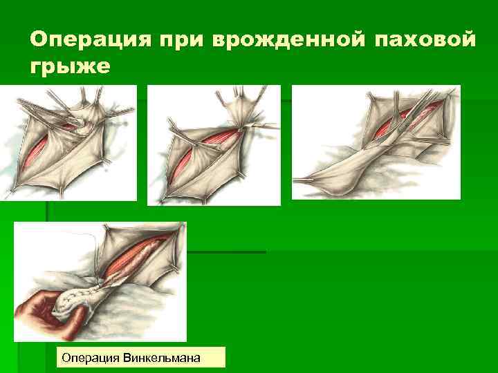 Операция при врожденной паховой грыже Операция Винкельмана 