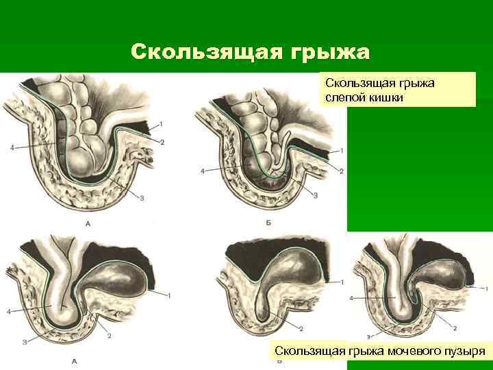 Скользящая грыжа слепой кишки Скользящая грыжа мочевого пузыря 