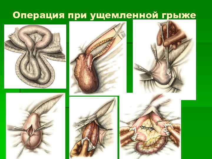 Операция при ущемленной грыже 