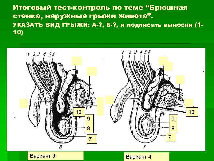 Итоговый тест-контроль по теме “Брюшная стенка, наружные грыжи живота”. УКАЗАТЬ ВИД ГРЫЖИ: А-? ,