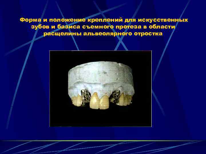 Форма и положение креплений для искусственных зубов и базиса съемного протеза в области расщелины