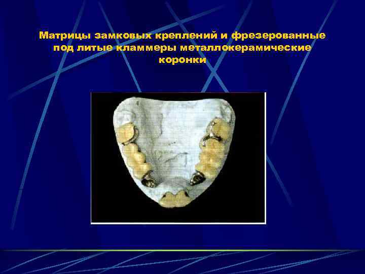 Матрицы замковых креплений и фрезерованные под литые кламмеры металлокерамические коронки 