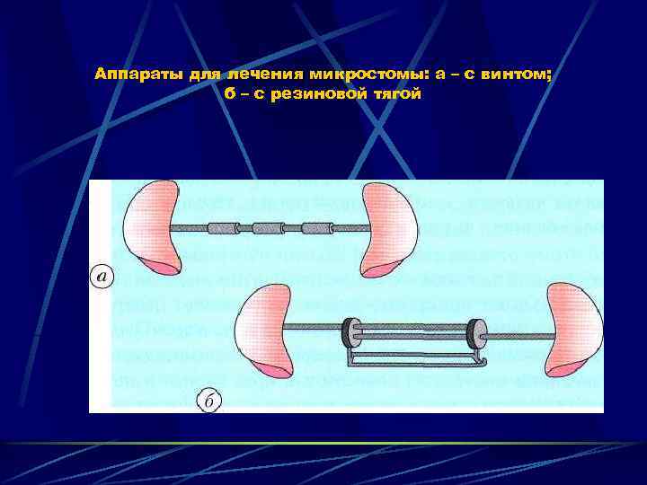 Микростомия этиология клиническая картина ортопедические методы лечения при микростомии