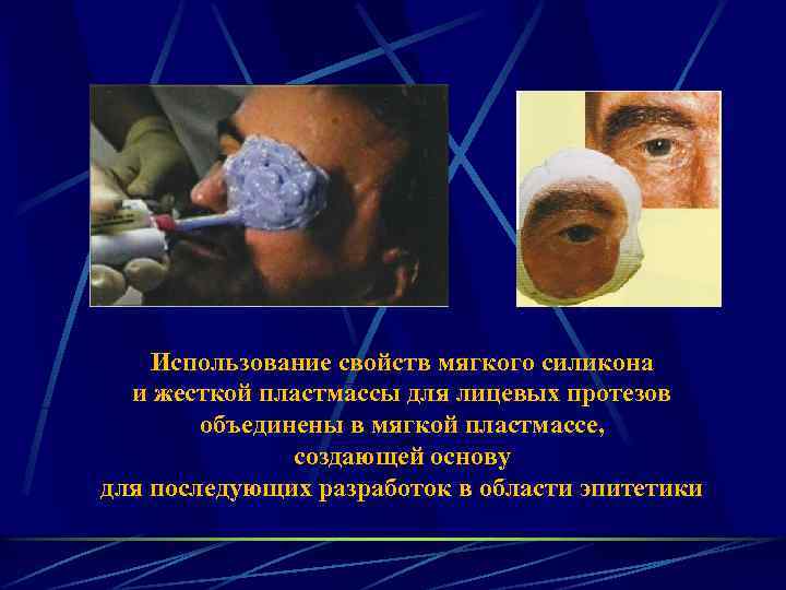 Использование свойств мягкого силикона и жесткой пластмассы для лицевых протезов объединены в мягкой пластмассе,