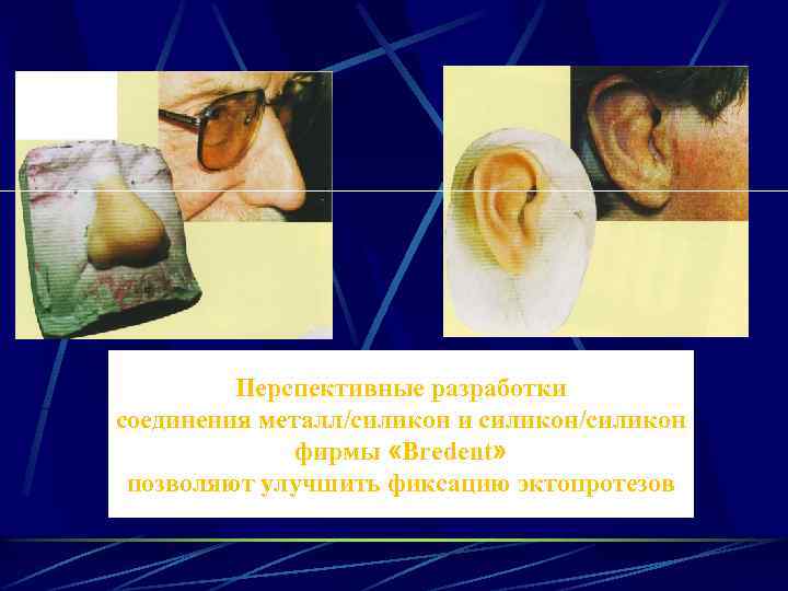 Перспективные разработки соединения металл/силикон и силикон/силикон фирмы «Bredent» позволяют улучшить фиксацию эктопротезов 