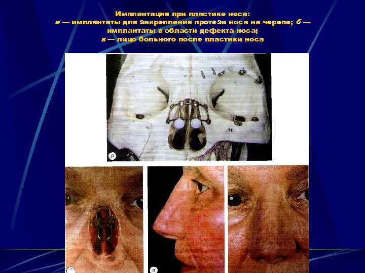 Имплантация при пластике носа: а — имплантаты для закрепления протеза носа на черепе; б