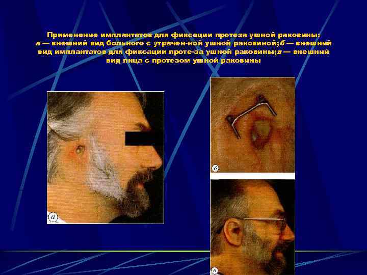 Применение имплантатов для фиксации протеза ушной раковины: а — внешний вид больного с утрачен