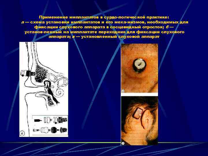 Применение имплантатов в сурдо логической практике: a — схема установки имплантатов и его меха