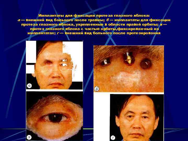Имплантаты для фиксации протеза глазного яблока: а — внешний вид больного после травмы; б