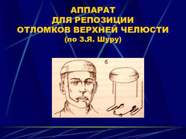 АППАРАТ ДЛЯ РЕПОЗИЦИИ ОТЛОМКОВ ВЕРХНЕЙ ЧЕЛЮСТИ (по З. Я. Шуру) 