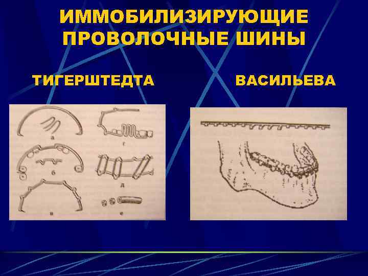 ИММОБИЛИЗИРУЮЩИЕ ПРОВОЛОЧНЫЕ ШИНЫ ТИГЕРШТЕДТА ВАСИЛЬЕВА 