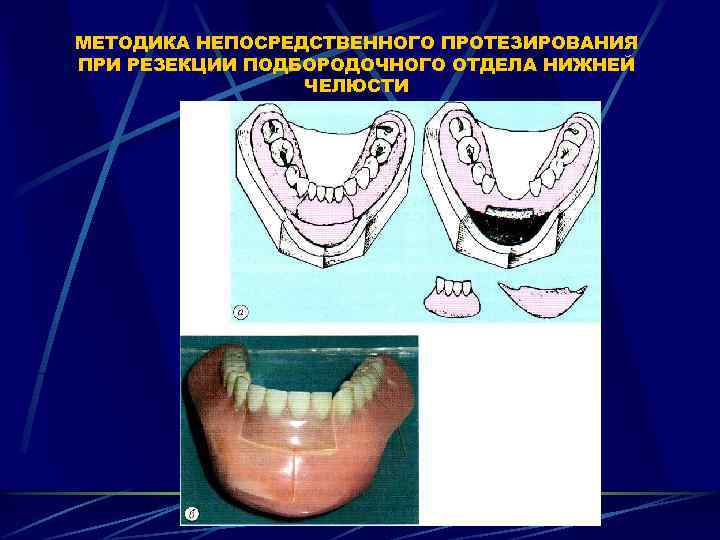 МЕТОДИКА НЕПОСРЕДСТВЕННОГО ПРОТЕЗИРОВАНИЯ ПРИ РЕЗЕКЦИИ ПОДБОРОДОЧНОГО ОТДЕЛА НИЖНЕЙ ЧЕЛЮСТИ 