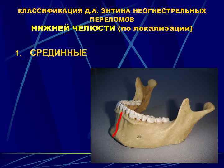 Этапы изготовления иммедиат протеза