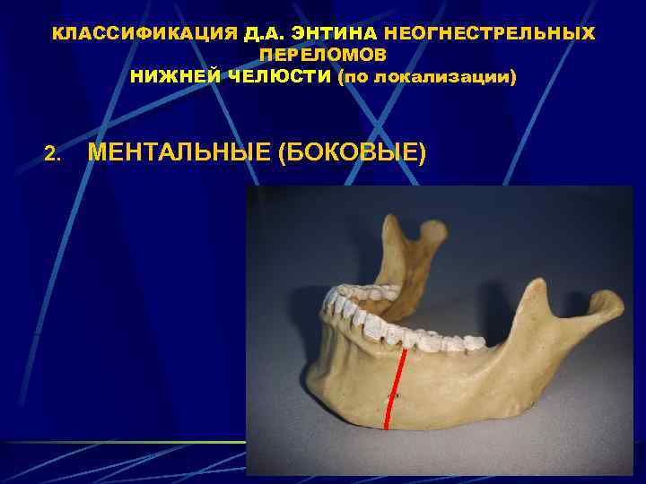 Перелом нижний. Ангулярный перелом челюсти. Переломы нижней челюсти классификация.