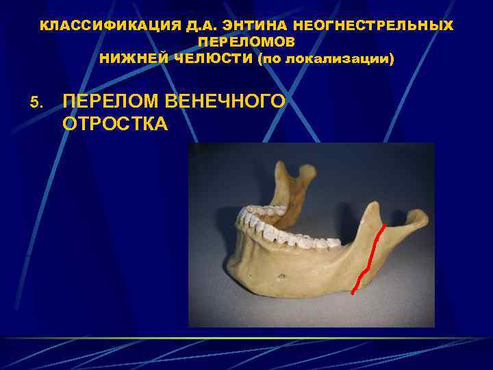 Перелом мыщелкового отростка нижней челюсти. Венечный отросток челюсти. Перелом венечного отростка нижней челюсти. Венечный отросток нижней челюсти. Перелом челюсти в области мыщелкового отростка нижней челюсти.