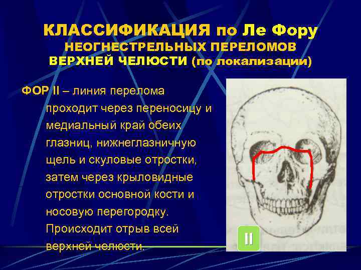 Перелом верхней челюсти презентация