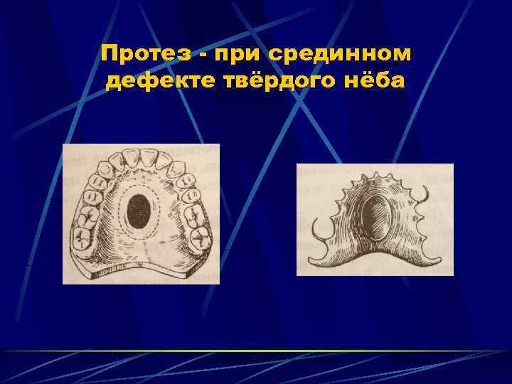 Протез при срединном дефекте твёрдого нёба 