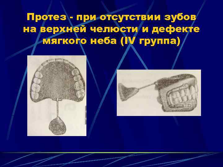 Протез при отсутствии зубов на верхней челюсти и дефекте мягкого неба (IV группа) 