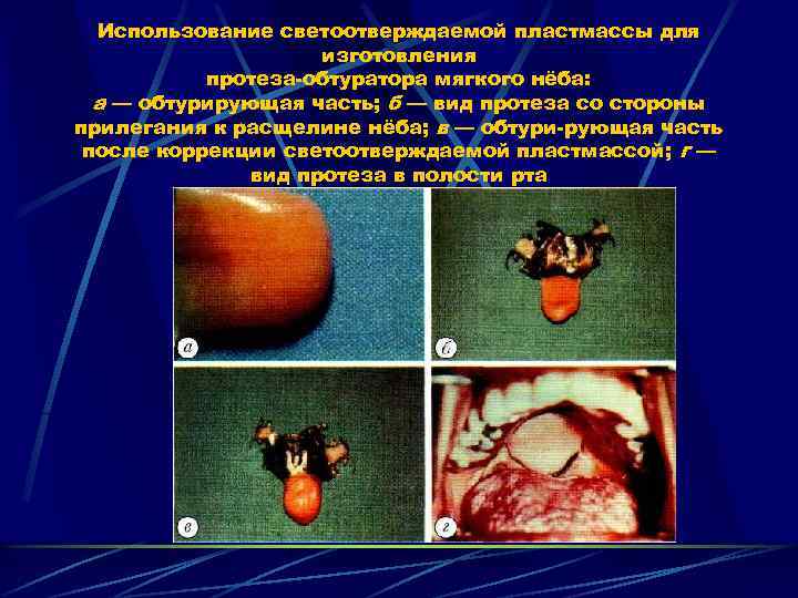 Использование светоотверждаемой пластмассы для изготовления протеза обтуратора мягкого нёба: а — обтурирующая часть; б