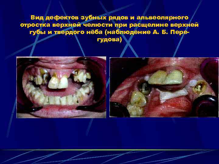 Вид дефектов зубных рядов и альвеолярного отростка верхней челюсти при расщелине верхней губы и