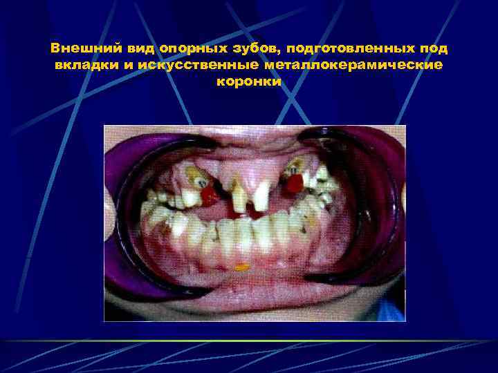 Внешний вид опорных зубов, подготовленных под вкладки и искусственные металлокерамические коронки 