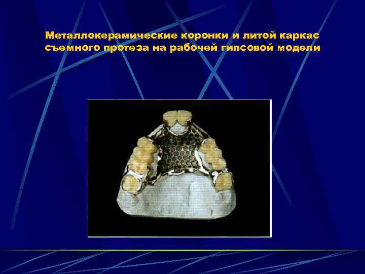 Металлокерамические коронки и литой каркас съемного протеза на рабочей гипсовой модели 