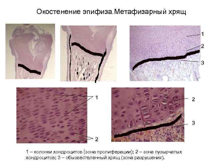 Окостенение эпифиза. Метафизарный хрящ 1 2 3 2 1 – колонки хондроцитов (зона пролиферации);