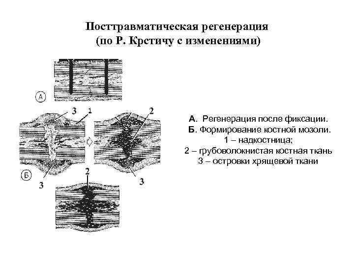 Посттравматическая регенерация (по Р. Крстичу с изменениями) А. Регенерация после фиксации. Б. Формирование костной