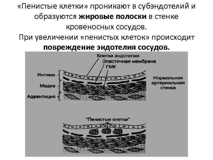  «Пенистые клетки» проникают в субэндотелий и образуются жировые полоски в стенке кровеносных сосудов.