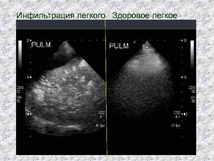 Инфильтрация легкого Здоровое легкое 