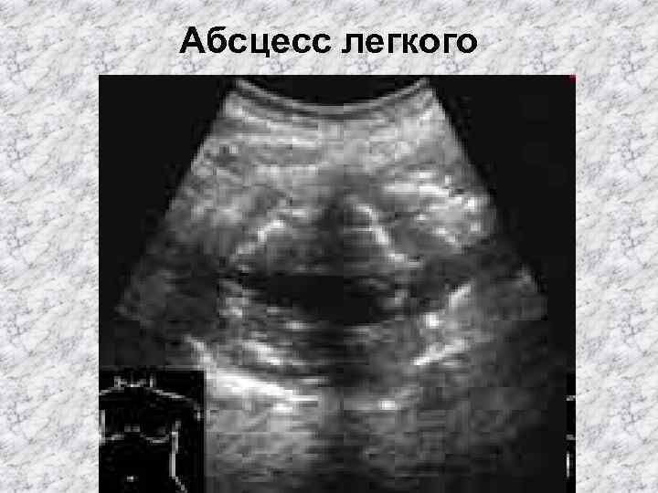 Абсцесс легкого 