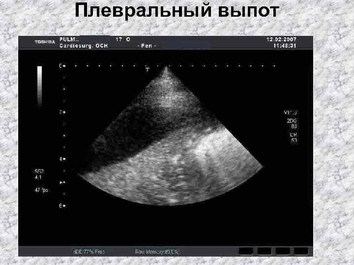 Плевральный выпот 