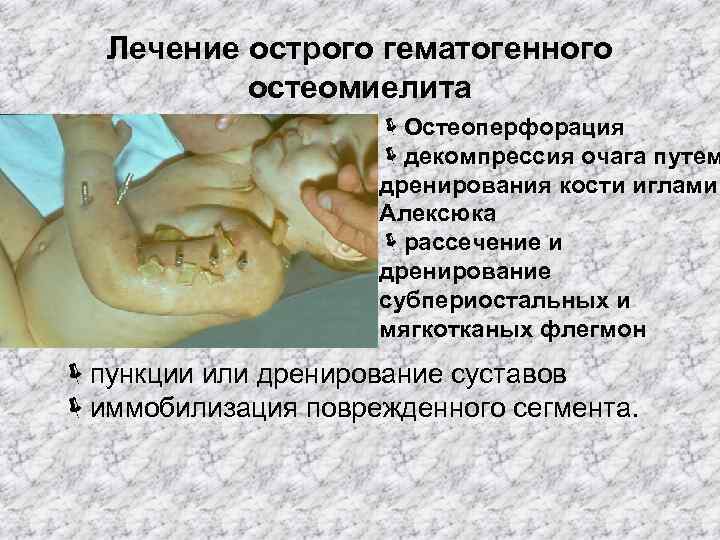 Лечение острого гематогенного остеомиелита ëОстеоперфорация ëдекомпрессия очага путем дренирования кости иглами Алексюка ëрассечение и