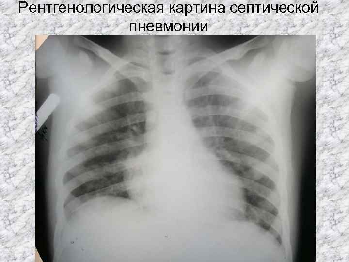 Рентгенологическая картина септической пневмонии 