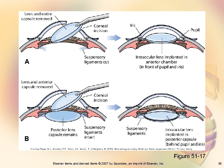 Figure 51 -17 Elsevier items and derived items © 2007 by Saunders, an imprint