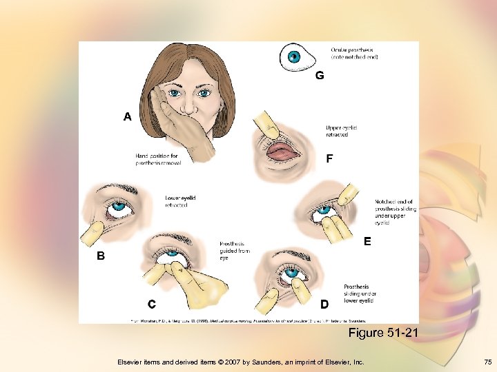 Figure 51 -21 Elsevier items and derived items © 2007 by Saunders, an imprint