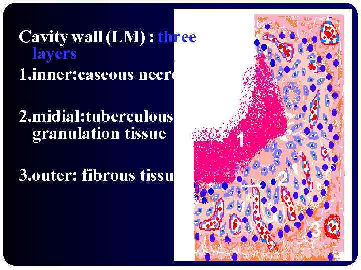 Cavity wall (LM) : three layers 1. inner: caseous necrosis 2. midial: tuberculous granulation